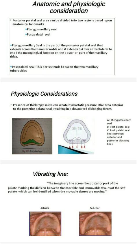 POSTERIOR PAlATAL SEAL AREA(PPS) | Seal, Restorative dentistry, Dentistry