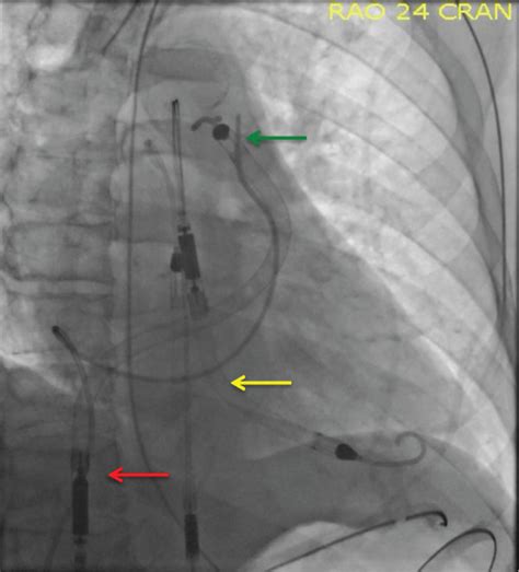 Chest X-ray showing RP Impella with the inlet situated in the inferior ...