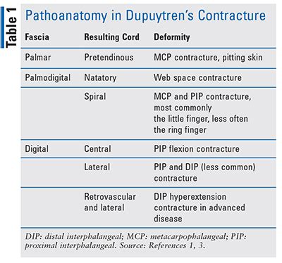 Correcting Dupuytren’s Contracture