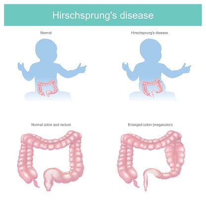 Hirschsprung Disease Affects The Large Intestine Of Newborns Babies It Makes Them Have Trouble ...