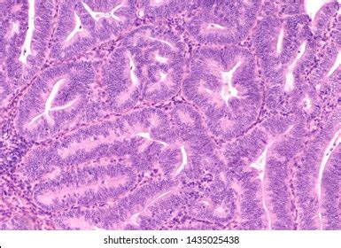 Histology Endometrial Biopsy Showing Complex Hyperplasia Stock Photo ...