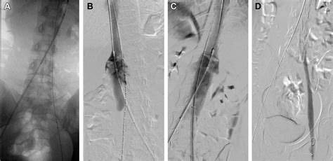 A unique case of acute bilateral internal iliac deep vein thrombosis leading to right ...