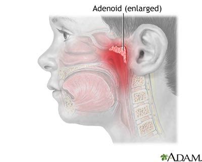 Apa Kata Dian: ADENOID??