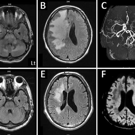 Relationship between hypertensive encephalopathy, PRES and RCVS ...