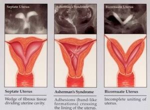 Uterine Septum - Infertility Causes - Dallas - Frisco Fertility - Center