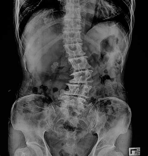 Adult Degenerative Scoliosis | Chibuikem Akamnonu, MD