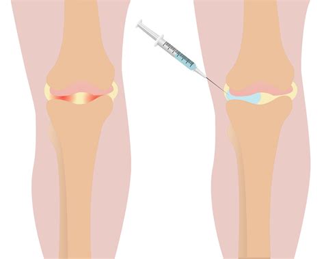 Types and Names of Injections for Knee Pain