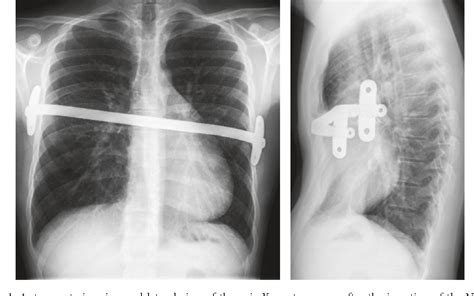 Figure 1 from Lung Middle Lobe Laceration Needing Lobectomy as Complication of Nuss Bar Removal ...