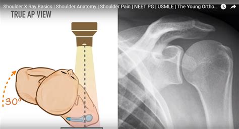 Radiological Anatomy of the Shoulder — OrthopaedicPrinciples.com