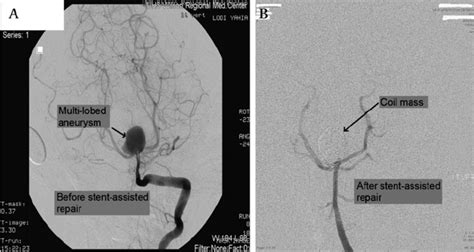 (A) A 42-year-old women presented with a subarachnoid hemorrhage Hunt... | Download Scientific ...