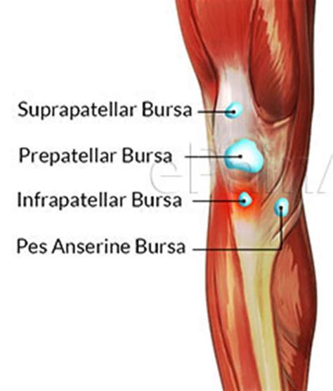 Knee Bursitis - Bakers cyst and Housemaids knee - Back in Action Physio