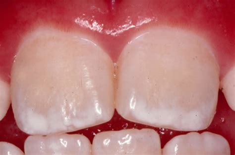 Dental fluorosis causes, prevention, symptoms & dental fluorosis treatment