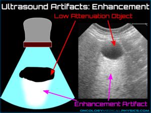 Ultrasound Artifacts | Oncology Medical Physics