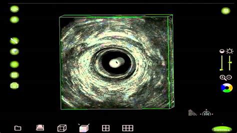 Transrectal ultrasonography of anorectal diseases: advantages and ...