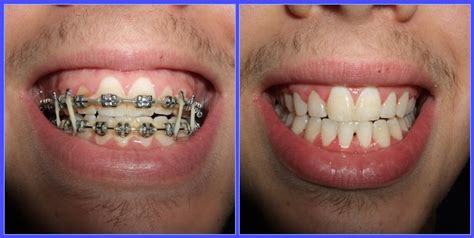 braces before and after | Dentgap