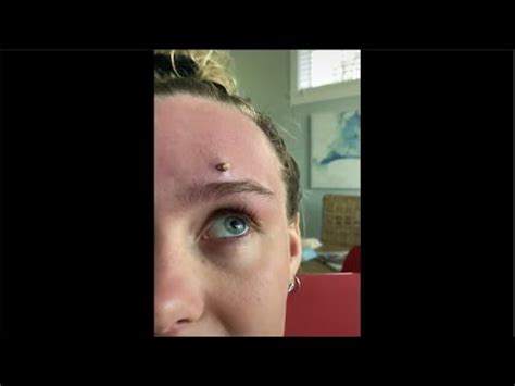 MOST Satisfying PIMPLE POPPING Moments 2020 - YouTube