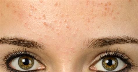 Forehead acne and pimples: Causes, treatment, and prevention