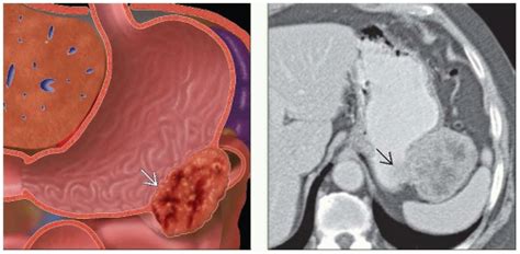 Gastric GIST | Radiology Key