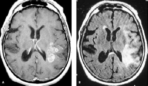 Frontal Lobe Tumor Surgery