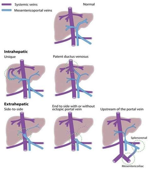 Children | Free Full-Text | Presentation of Congenital Portosystemic ...