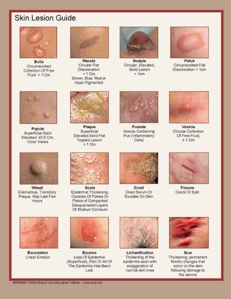 Share Everything: Gambaran Jenis Kelainan Pada Kulit (Skin Lesion Guide)