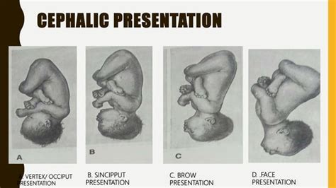 Cephalic presentation