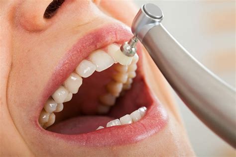 How Long Should a Dental Cleaning Take | Dental Checkup