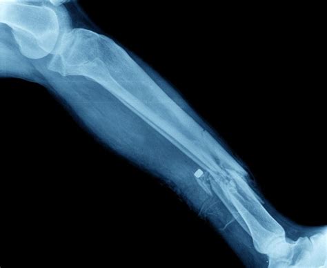 What are Compound Fractures? - Facty Health