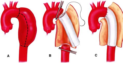 Descending thoracic aorta replacement