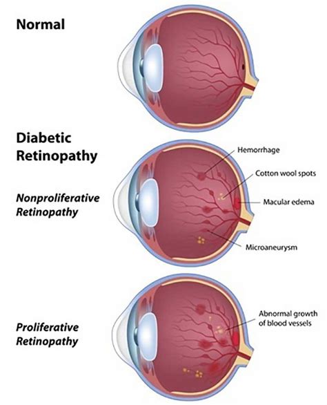 Diabetic Retinopathy; Symptoms, Causes, Complications & Treatment