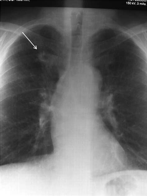 Pulmonary Nodulosis and Aseptic Granulomatous Lung Disease Occurring in Patients with Rheumatoid ...