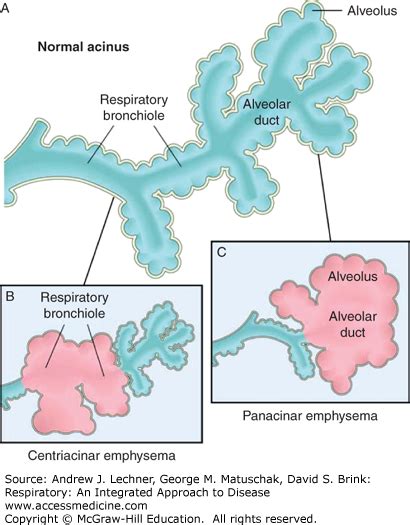 Pathology of Obstructive Pulmonary Diseases | Thoracic Key