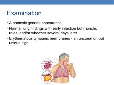 Mycoplasma Pneumonia