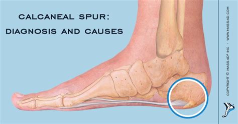 Calcaneal enthesophyte: symptoms and treatments - Healthy Food Near Me