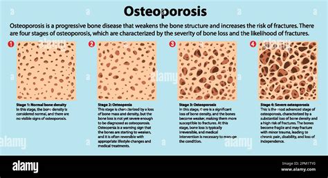 Bone Density and Osteoporosis Vector illustration Stock Vector Image & Art - Alamy