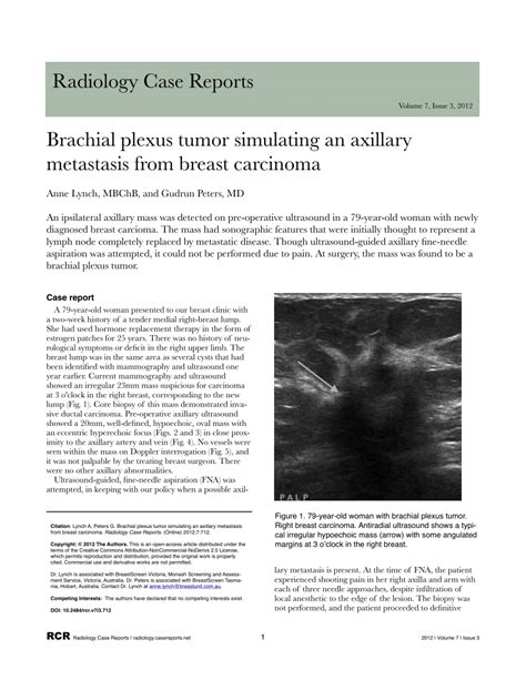 (PDF) Brachial Plexus Tumor Simulating an Axillary Metastasis from Breast Carcinoma: A Case Report