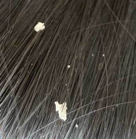 Dandruff Flakes In Hair