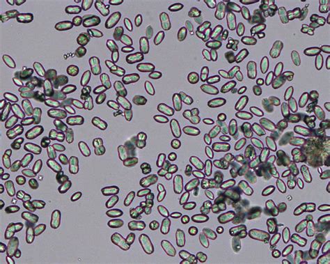 Calcium oxalate monohydrate (hemp seed variant) | eClinpath