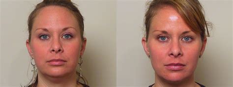 Neck Lift (Submentoplasty) Before and After Pictures Case 37 | Atlanta, Georgia | Buckhead ...