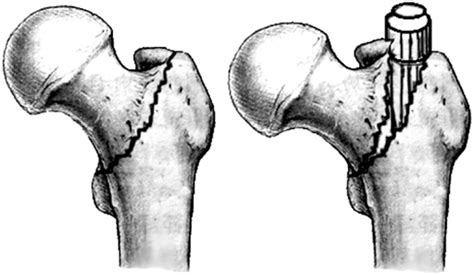 Surgical Treatment of Basicervical Intertrochanteric Fractures of the ...