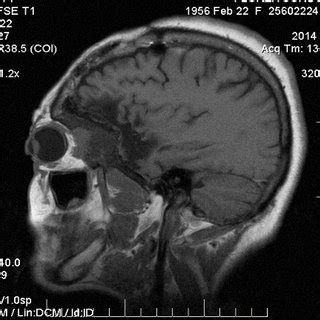 -Preoperative skull X-ray showing hyperostosis of the right sphenoid... | Download Scientific ...