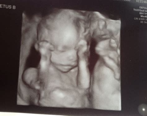 18 Week - Level 2 Ultrasound - Our Journey to Twins