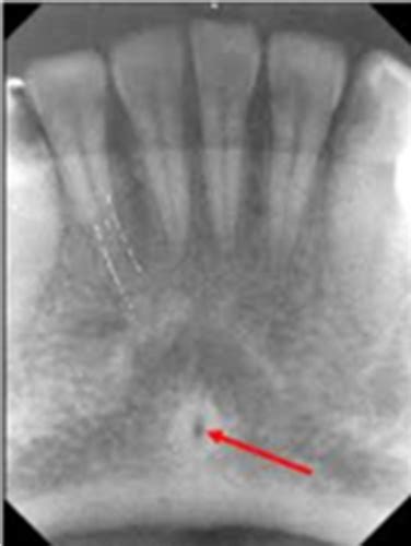 Genial Tubercle X Ray