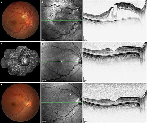 Case 2. Fundus photographs, optical coherence tomographic (OCT) images ...