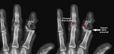 Introduction to Trauma X-ray - Fracture complications