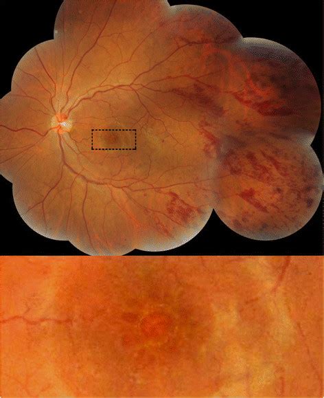 Color fundus photography of the patient. Flame-shaped hemorrhages are... | Download Scientific ...