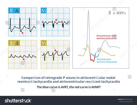 Retrograde P Wave Avnrt Closer Qrs Stock Illustration 1839327526 | Shutterstock