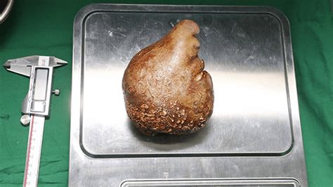 The World's Largest Kidney Stone Has Just Been Removed From A Man In Sri Lanka | IFLScience