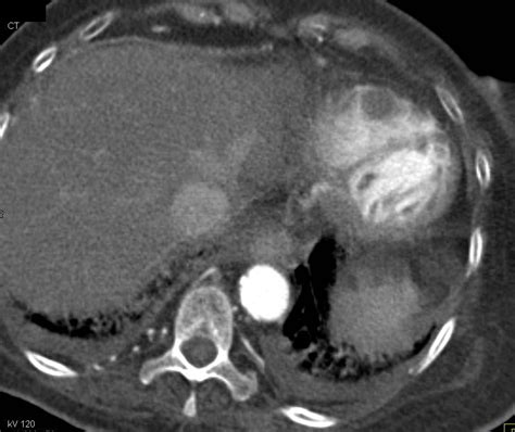 Thrombus Of Left Atrial Appendage