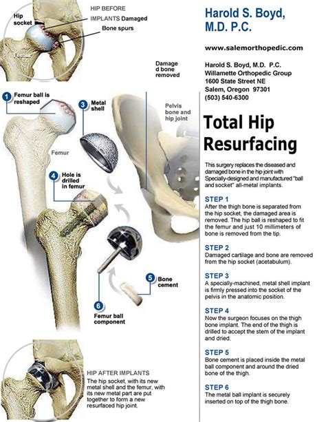 Total Hip resurfaceing - Harold S. Boyd, M.D. - Learn more about Total ...